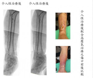 嚴重周邊動脈阻塞性疾病恐將面臨截肢命運經高壓氧治癒後情形（記者陳華興攝）