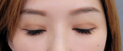 加法雙眼皮移植筋膜，減少肉條感，呈現自然雙眼皮眼褶。