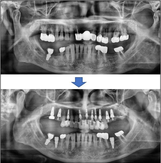 六十歲男性患者因嚴重的牙周病，幾乎快要成無齒之徒，治療中，由X光影像即可看出大幅改善。