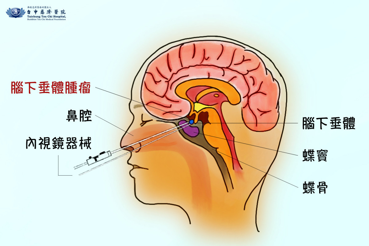 腦下垂體瘤手術示意圖。