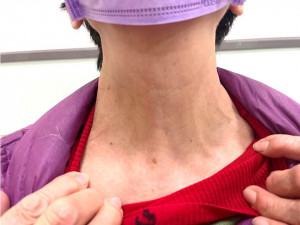 嘉義基督教醫院以達文西手術系統，為患者進行甲狀腺切除手術，不僅腫塊消除，聲音不會沙啞，且頸部不留痕跡／嘉基提供