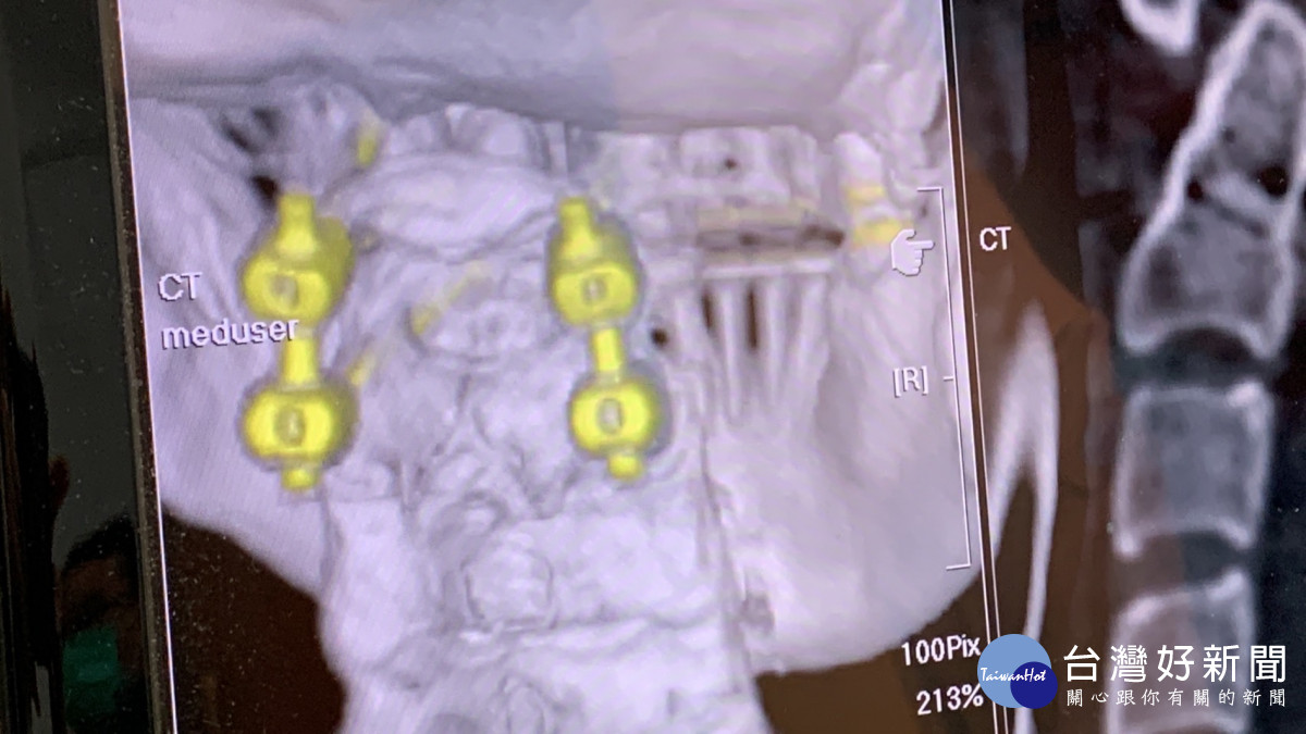 利用AR與3D立體導航成功且安全執入固定第一與第二頸椎的骨釘，讓患者免於四肢癱瘓。曾雪蒨攝