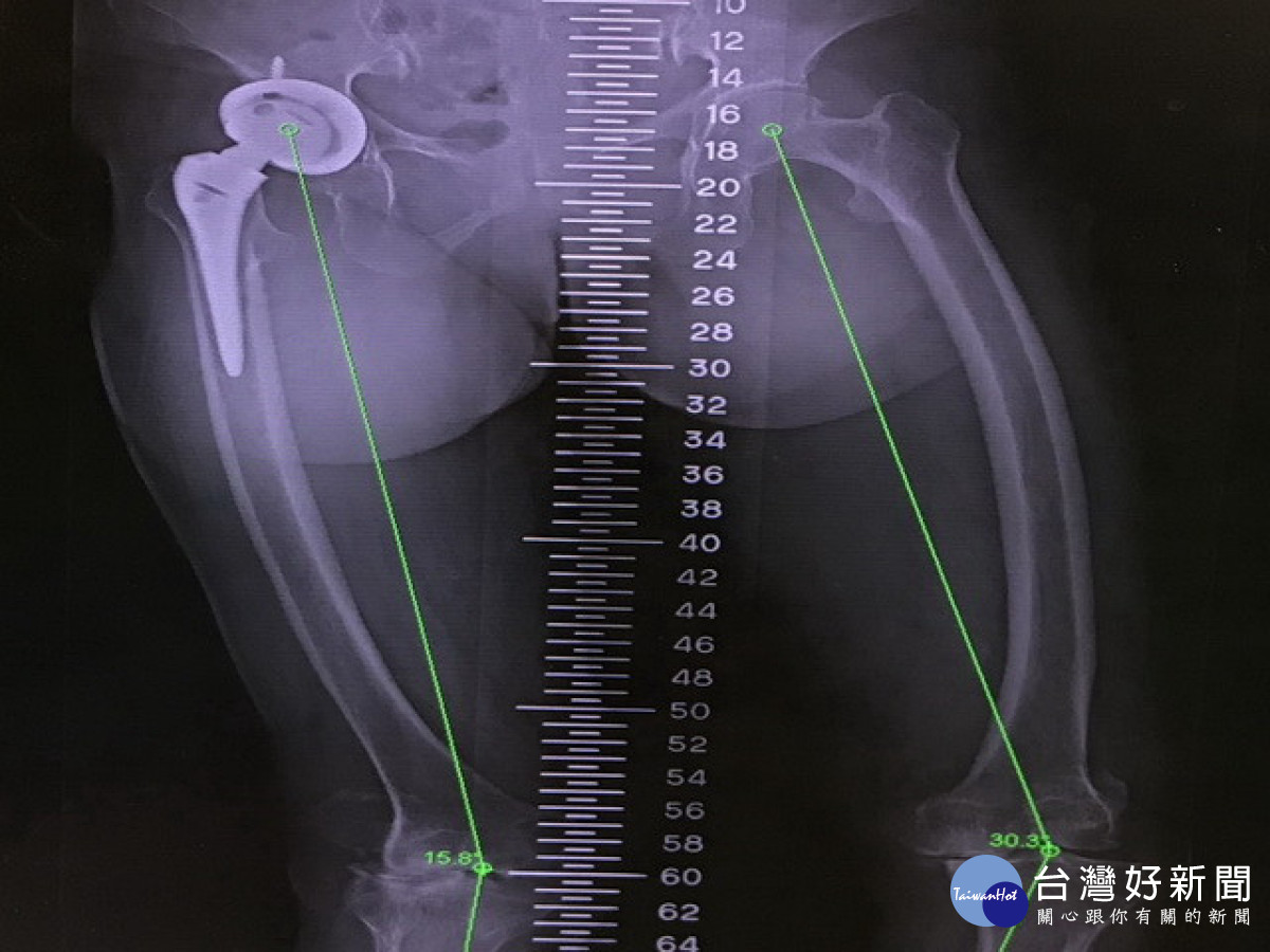 關節變形。林重鎣翻攝