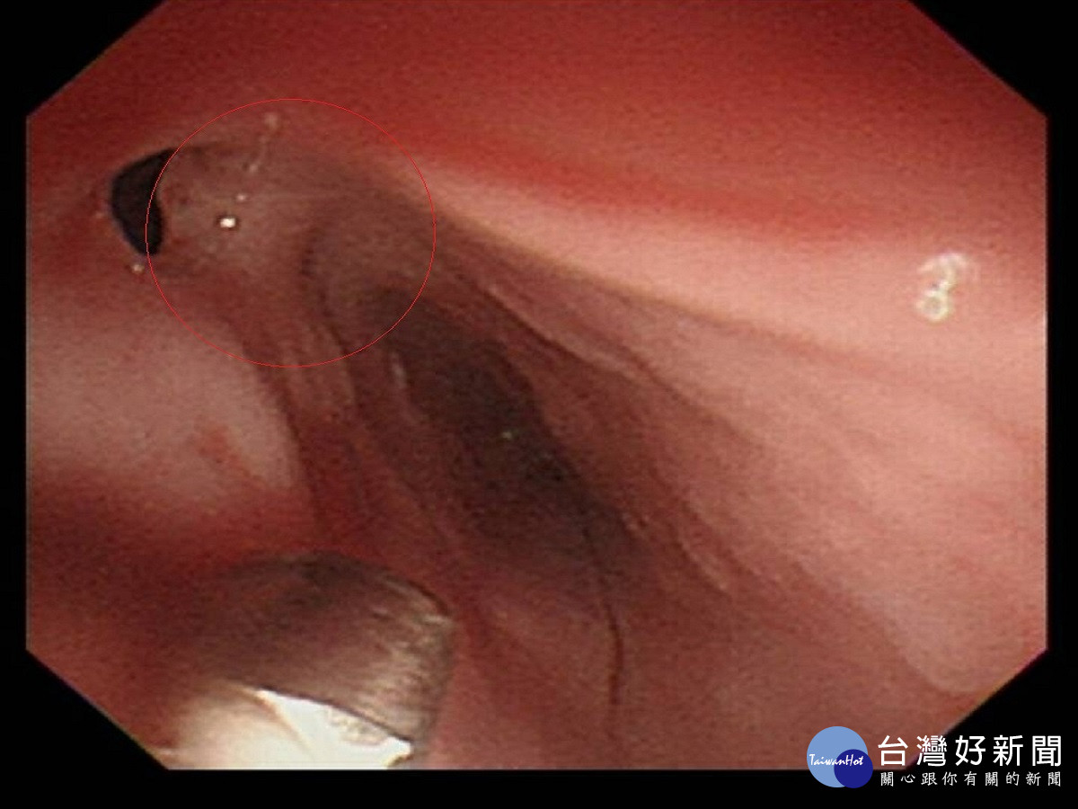 喉嚨好像卡住拖半年已食道癌末　醫師切道脫離險展開復健