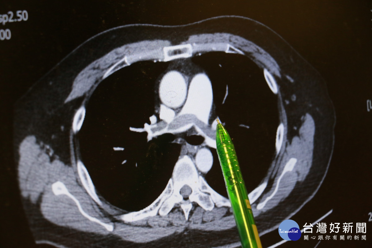病人肺部兩側大片瀰漫的血栓。