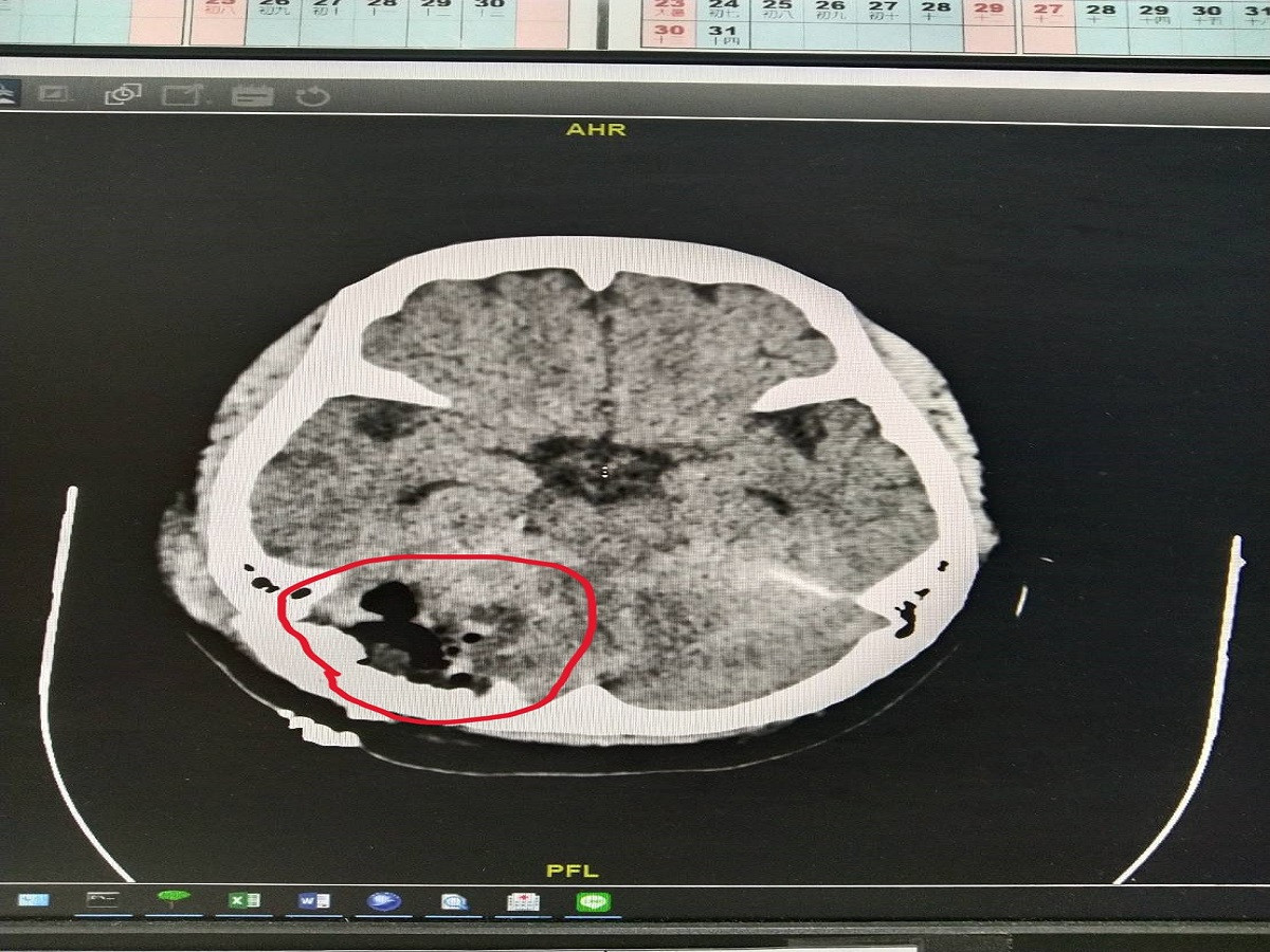 頭昏目眩竟是腦瘤作崇術前心臟又出問題　員榮、中榮聯手 先開心再開腦病人如今恢復良好