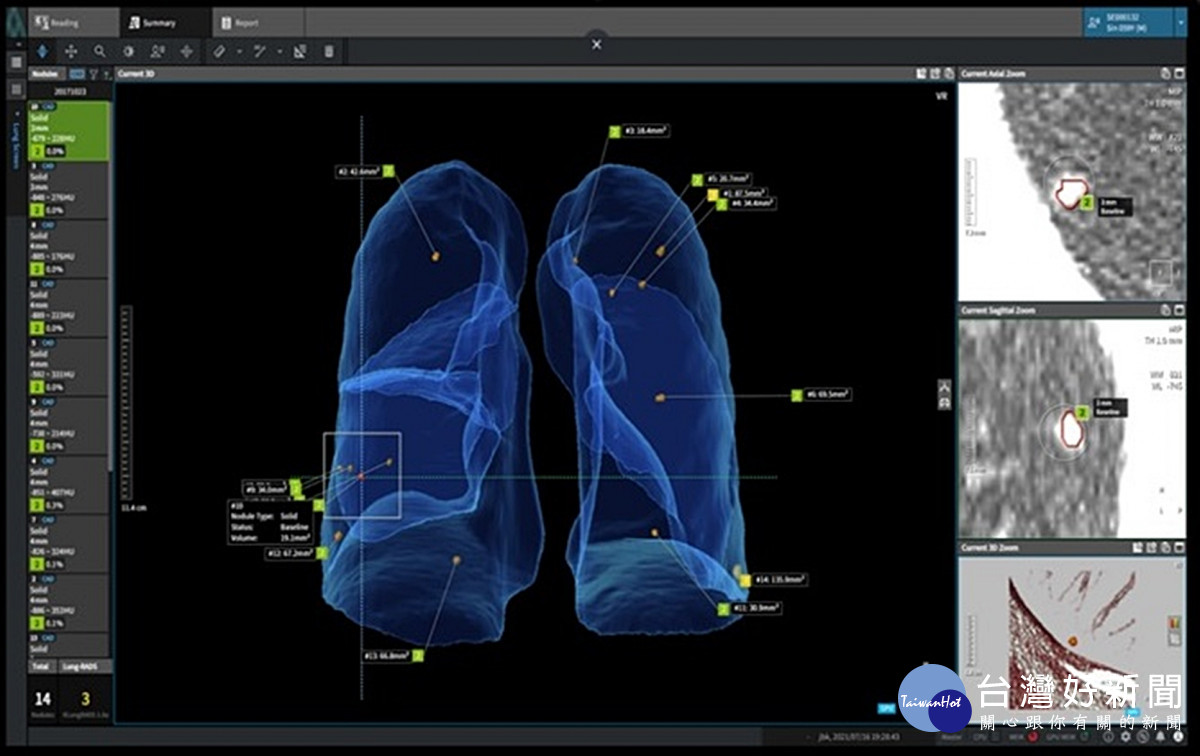 北榮桃園分院運用肺癌AI判讀軟體　推動智慧醫療