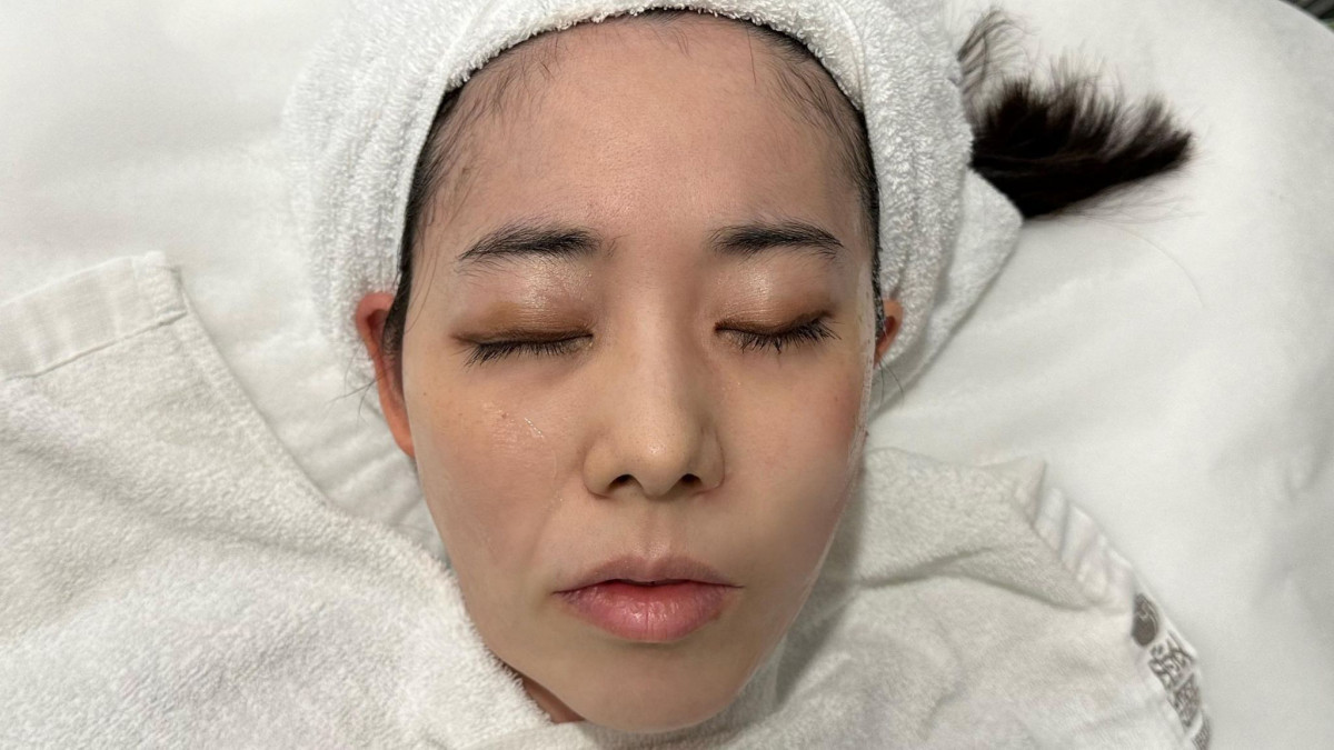 右半臉為患者施打龍捲風密集音波的立即效果。（圖／愛爾麗診所提供）