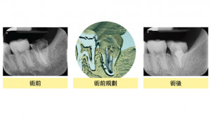 張紘銘醫師說明，病人術後恢復咀嚼功能，並經追蹤十五個月，臨床及X光檢查，移植牙皆無異狀。