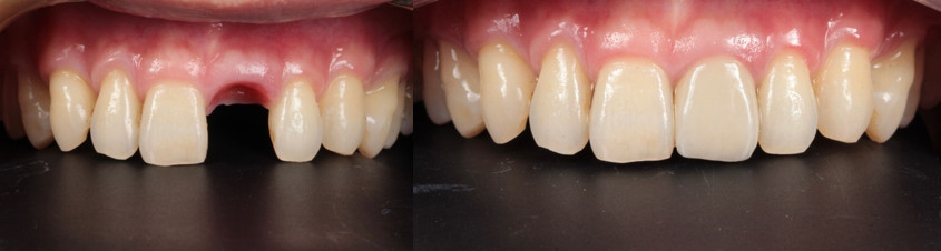 即拔即植案例分享，門牙缺損後的重建治療更快更不痛，如真齒般自然。（手術醫師：陳泰龍醫師／假牙醫師：范姜郁欣醫師 品味牙醫）