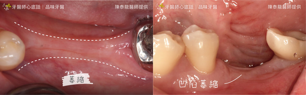 齒槽骨骨量過少、牙齦萎縮，有可能不是即拔即植適宜對象，需進一步評估。（圖／牙醫師心底話部落格 ）