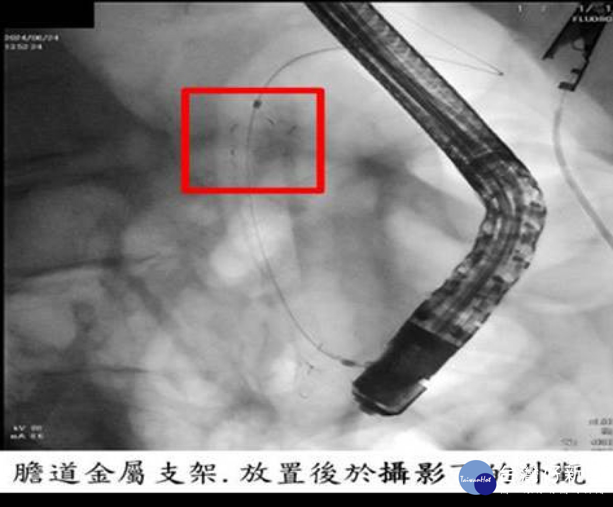 膽道金屬支架，放置後於攝影下的外觀。