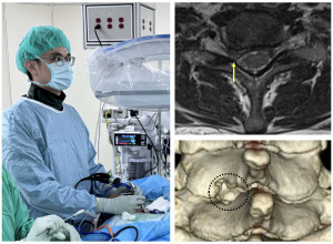 徐秋豪醫師為病人執行內視鏡椎間盤切除手術，術前核磁共振顯示椎間盤突出(箭號)