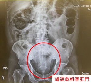 病人延遲就醫，就診時惡性軟組織肉瘤已增大(箭頭標示)。