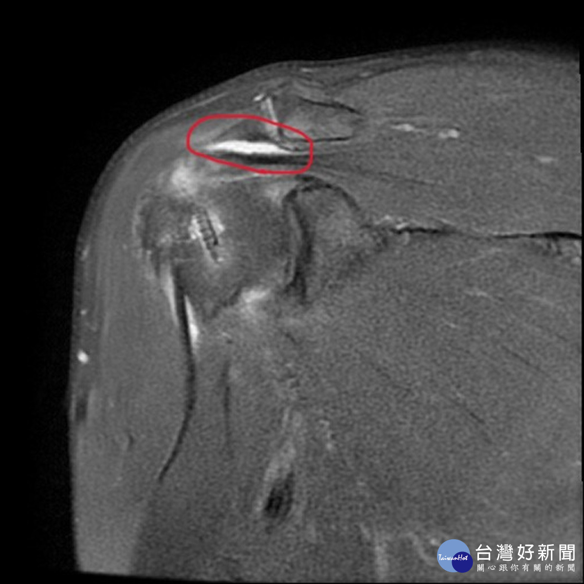 男肩膀痛到睡不著兩度手術才緩解　醫師：長期搬重物、游泳、棒球投手都要注意 台灣好新聞 第2張