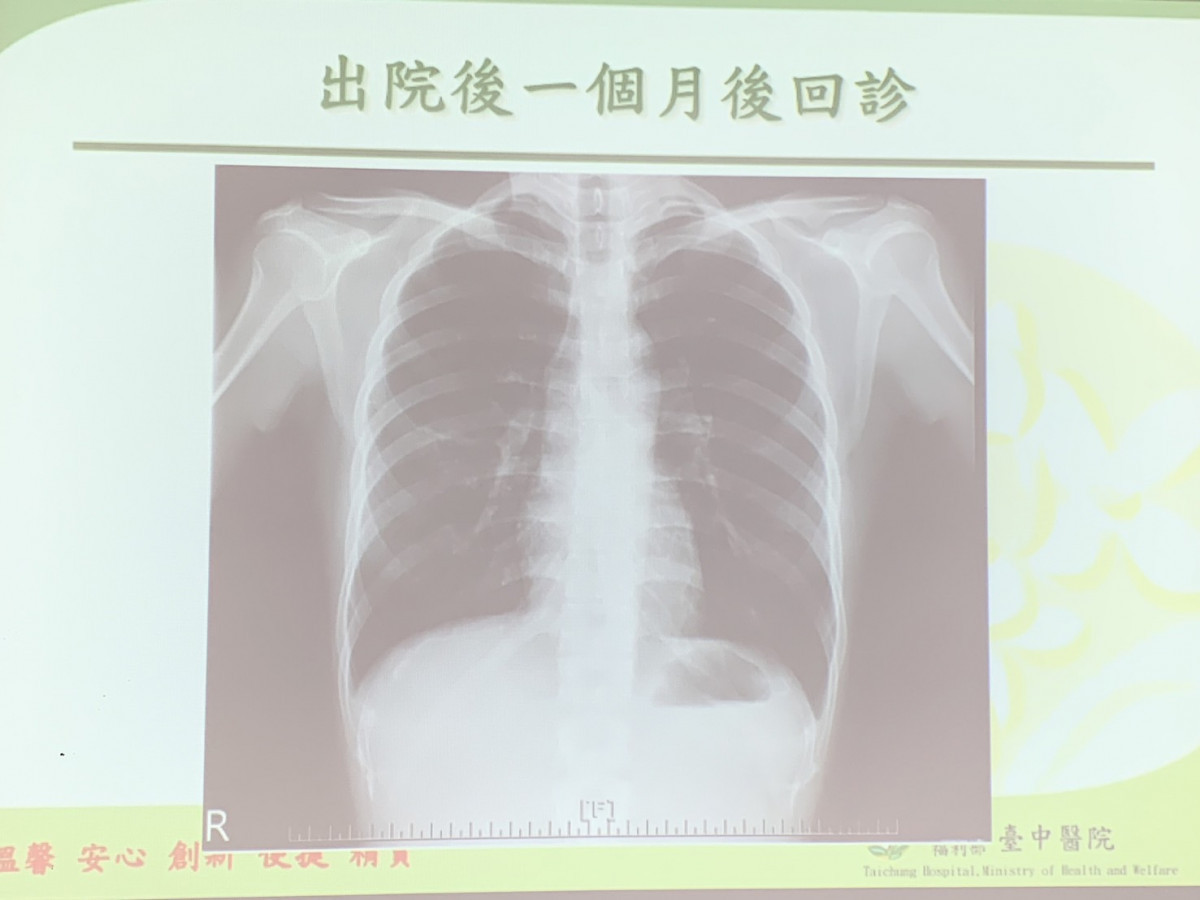 女大生感冒一週後道院右下感染一大片肺炎的狀況。