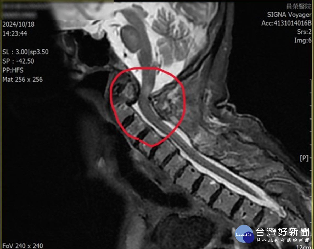 婦人跌倒頸椎骨折被誤為帕金斯症　員榮神內外醫師聯手診治如今已康復