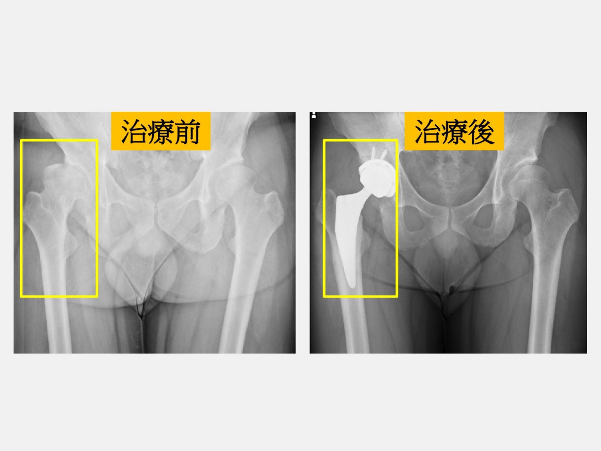 擺脫早發性髖關節炎　微創正前開人工髖關節手術助重返球場 台灣好新聞 第2張