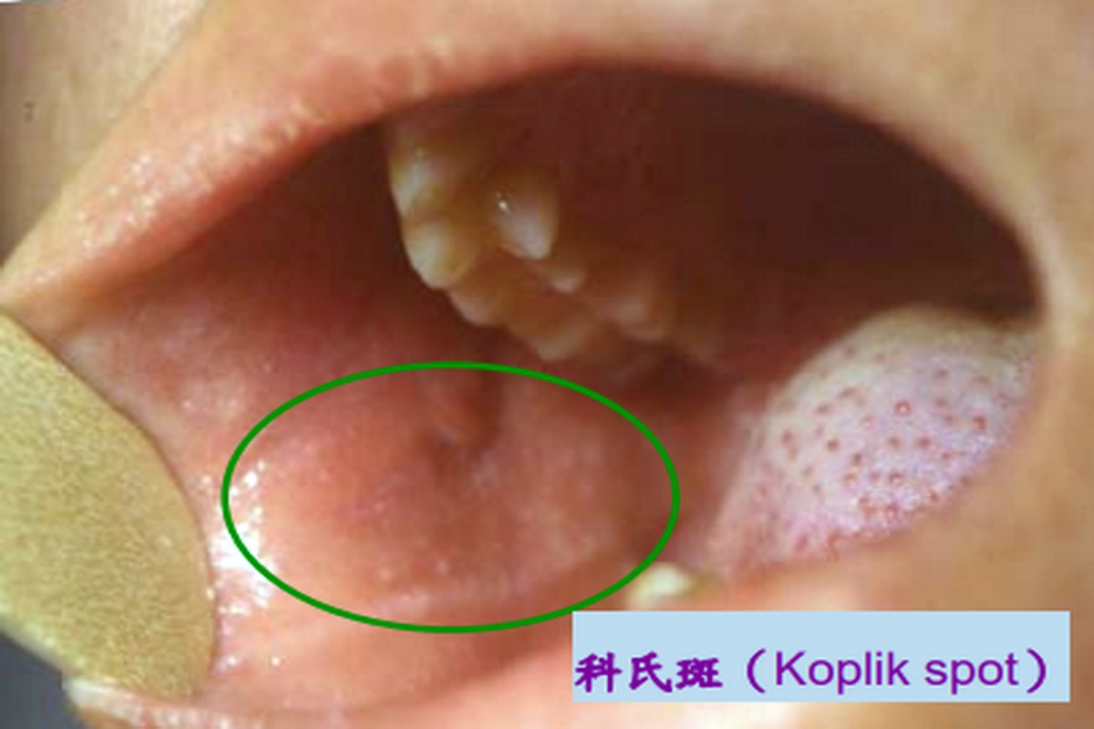 科氏斑。（資料來源：高雄長庚醫院黃高彬部長提供）<br />
