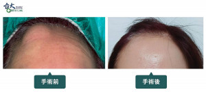 額部骨瘤手術前（左）與手術後（右）的外觀比較。新竹臺大分院整形外科張晏誠