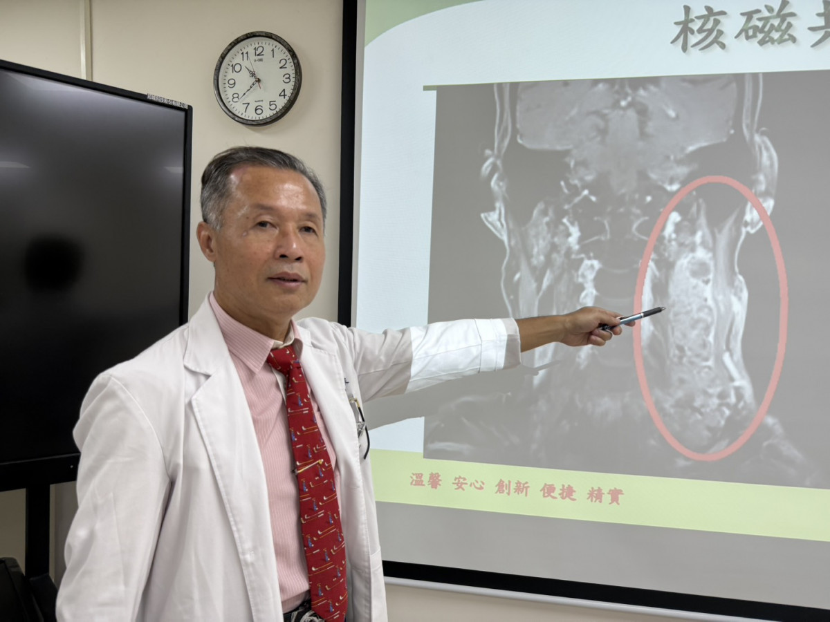 衛生福利部臺中醫院耳鼻喉科鄭政宗醫師說明患者左頸部微凸部位，就醫進一步檢查竟發現是12公分長巨大腫瘤。圖/台中醫院