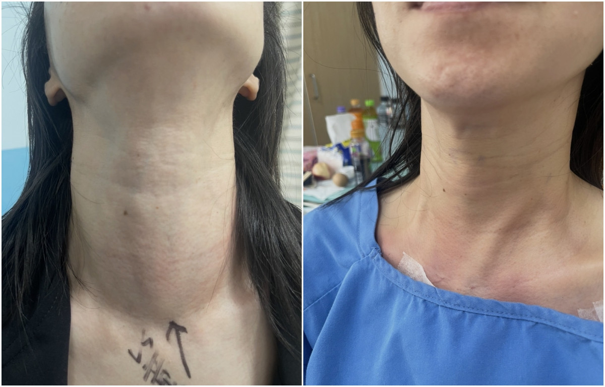 部桃達文西再突破　    甲狀腺手術破百例（左圖術前、右圖術後）