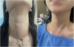 部桃達文西再突破　    甲狀腺手術破百例（左圖術前、右圖術後）