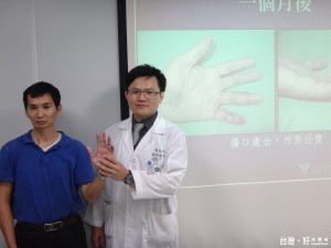 佳里奇美醫院整形外科主治醫師林祐丞，採用交指皮瓣重建手術讓病患把 陳 先生回復指腹最原始的外觀。