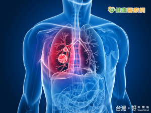 揪出肺癌循序漸進　可用哪些武器？