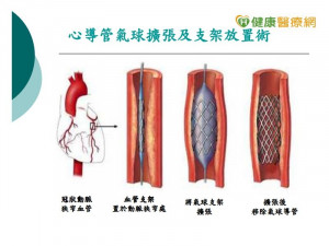 治血栓用吸的？　醫：網路謠言勿輕信