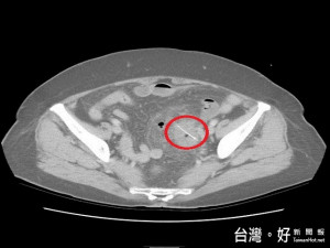 老婦人肚內魚刺。林重鎣翻攝