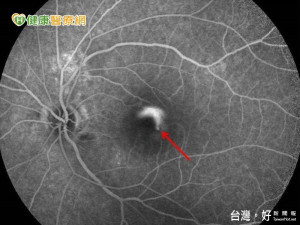 單眼視力突下降　光動力療法縮短病程