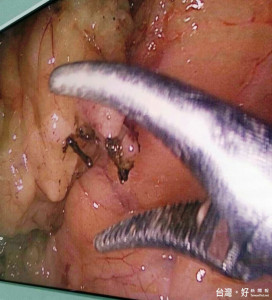 精障婦女吞食小彈珠就醫　意外發現鏽鐵釘穿小腸達2年沒事