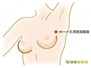 乳癌死角！　小心乳腺末端乳房腋尾處