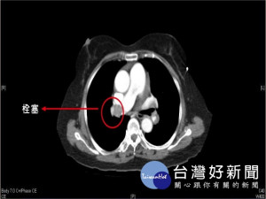 大甲李綜合醫院醫療團隊，急救回患急性肺栓塞70歲吳老太太，急診

室主任張宏文指該病情症狀明顯，會出現呼吸困難急促等情況，未急

時治療，有失去生命之虞。（記者陳榮昌攝）