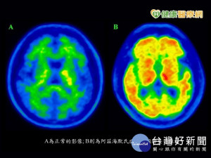 透過新型試劑　加速確診失智原因