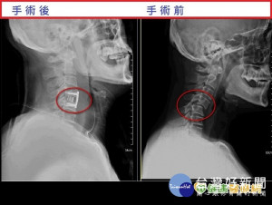 跌倒後頸部痠痛　竟是頸椎脫位惹禍