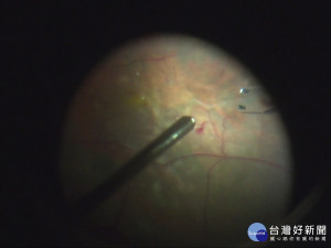 黃斑部微創手術建功 四年治癒兩千案例