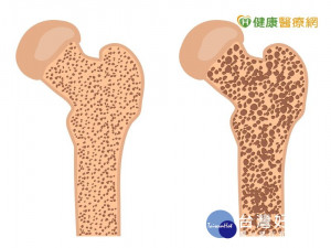 驚！　10年內4人有1人將成為骨鬆族