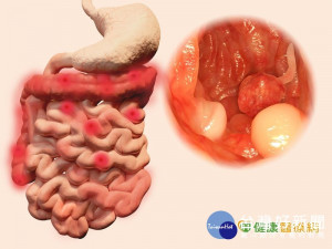 豬哥亮癌末病逝　你該知道的大腸癌防治