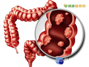 每天15人死於腸癌　篩檢可降5成死亡風險