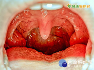 自我檢測口腔　3大症狀恐是癌症前兆