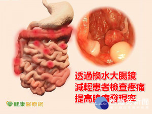 換水大腸鏡檢查　有效提升腺瘤發現率