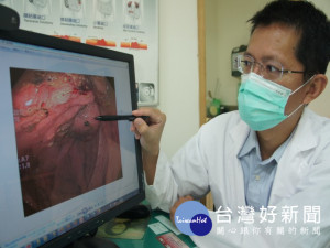 大甲光田醫院醫師吳喬森說明罹患大腸癌的身體狀況，籲民眾每3年

就要做一次大腸鏡檢查，確保身體健康。（記者陳榮昌攝）