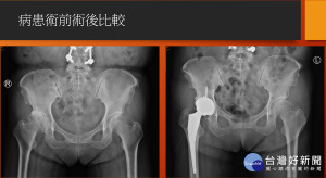 病人術前術後X光比較。（圖／七賢脊椎外科醫院提供）