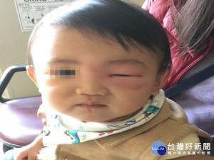 小朋友被叮一口眼腫大。照片醫院提供