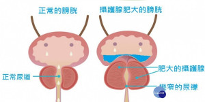 大齡老爸頻繁跑廁所 恐是攝護腺肥大在作怪