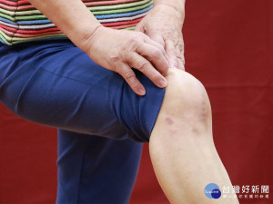 牛津半膝人工關節置換手術幫助病患快速恢復，不影響生活品質。（圖/記者郭文君 攝）