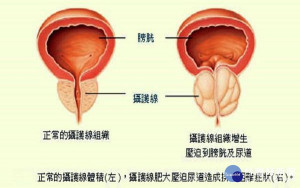 攝護腺肥大。