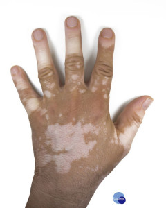 skin depigmentation on mans hand